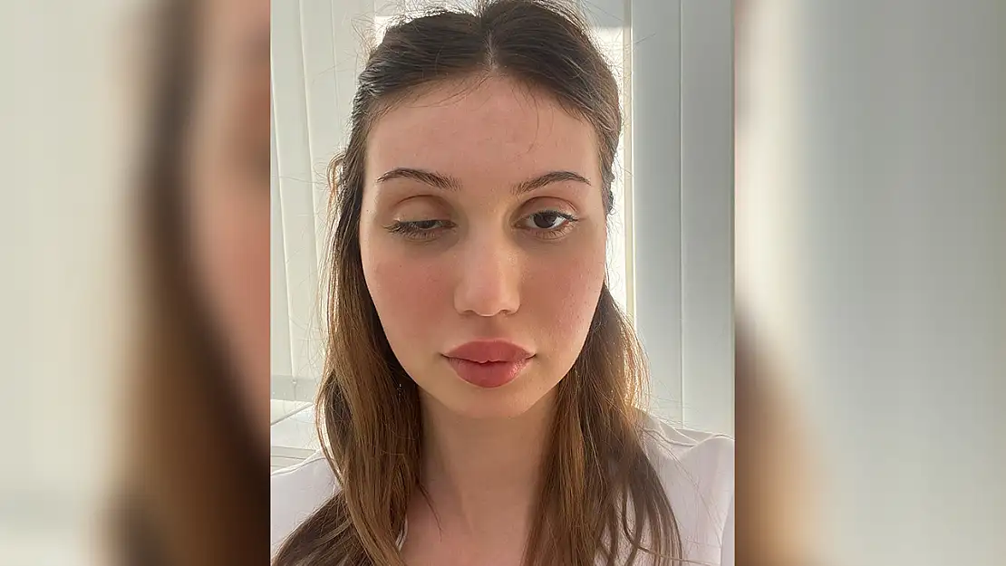 Botoks yaptıran kadının  göz kapağı düştü