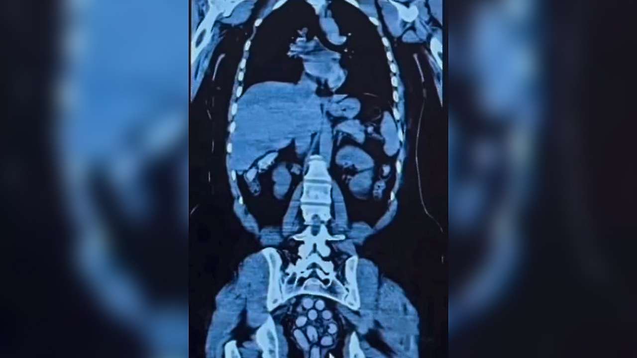 Röntgen filmini gören polisler şaştı: Midelerinden kilolarca çıktı