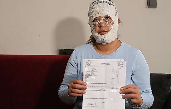 Güzelleşmek uğruna yüzünden oldu!