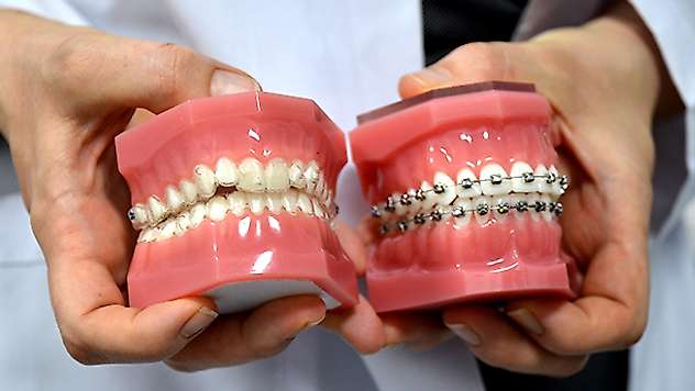'Şeffaf plak' uygulaması hastaları 'diş teli' tedavisinin zahmetinden kurtarıyor