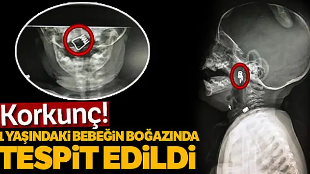 1 yaşındaki bebeğin boğazına mandal yayı saplandı