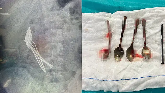 15 yaşındaki çocuğun midesinden 4 kaşık ve 1 çivi çıkarıldı
