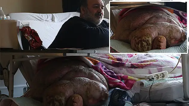 5 yıldır evden çıkamayan 300 kiloya ulaşan fil hastasının hayali eşiyle kol kola caddede gezmek