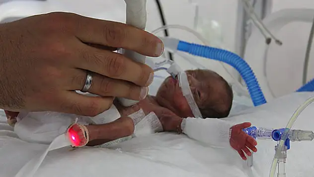 514 gram doğan bebeğe 'hayat' operasyonu