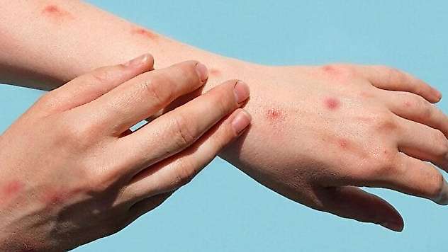'Ankara'da 4 kişi, M çiçeği şüphesiyle karantinaya alındı' iddiası yalanlandı
