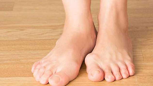 Başparmak çıkıntısı olarak bilinen 'halluks valgus' kadınlarda 10 kat daha fazla görülüyor

