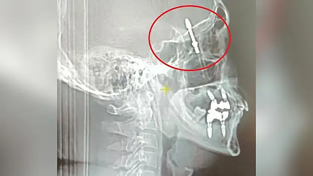 Beynine saplanan implant hayatını kararttı: 2 yıldır adalet bekliyor