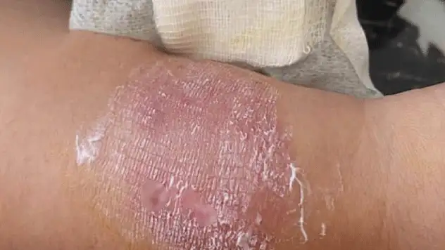 Sigara dumanı tartışmasında kolunu ısırdı