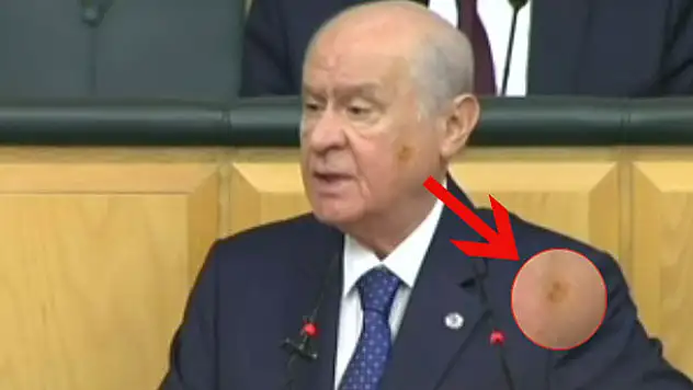 Devlet Bahçeli'nin yüzüne ne oldu?