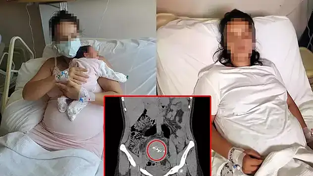Doğumda annenin vücudunda unutulan gazlı bez, 2 yıl sonra fark edildi
