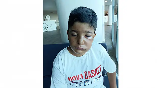 Enfeksiyonlu dişi çekilen 8 yaşındaki çocuk az kalsın gözünden oluyordu
