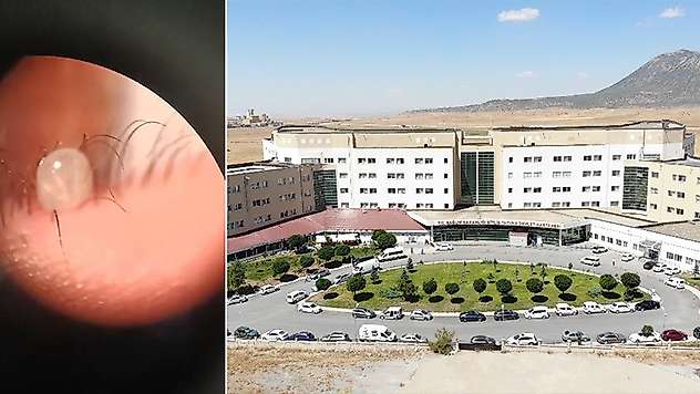 Hastanın gözünde canlı kene çıktı
