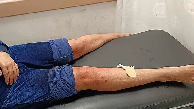 Hatay'da sahipsiz köpeklerin saldırısına uğrayan kadın yaralandı
