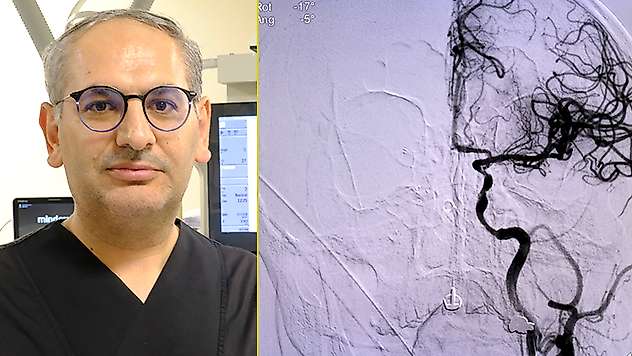 İnmede erken müdahale hayat kurtarıyor

