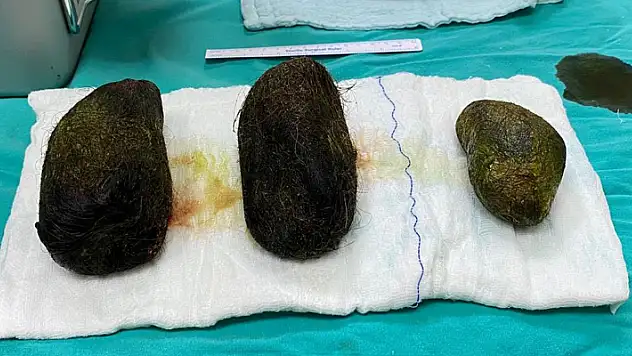 Karın ağrısı şikayetiyle hastaneye başvuran kadının midesinden 2 kilo saç çıktı
