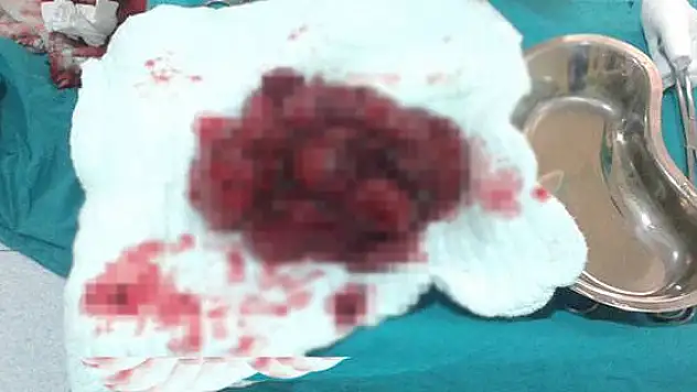 Karnından 3 kiloluk kitle çıktı