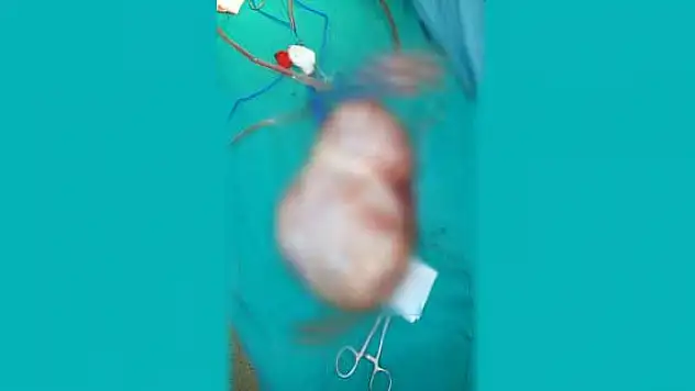 Karnından top büyüklüğünde kist çıktı