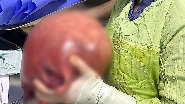 Kilo aldığını sandı, rahminden 5,5 kilo kitle çıktı
