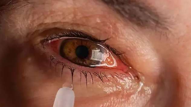 Kışın artan göz salgınına dikkat
