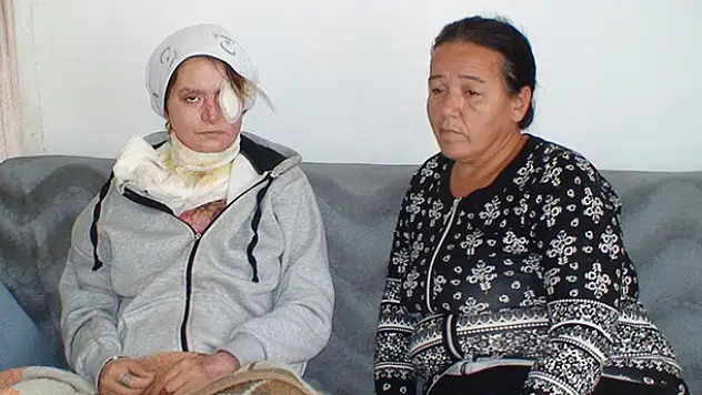 Konya'da Kocasının Kezzapla Yaktığı Kadın Yardım Bekliyor