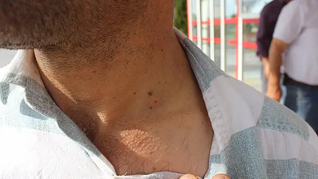 Konya'da biçerdöver işçisinin boğazına kene yapıştı