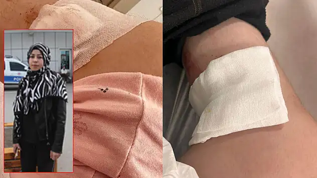 Konya'da ziraat mühendisi kadın, sokak köpeğinin saldırısında yaralandı!
