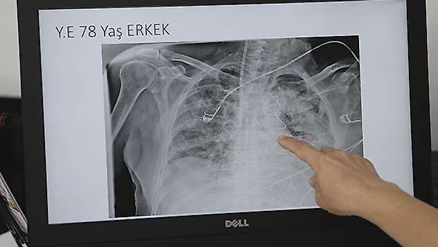 Koronavirüsün akciğerdeki ağır tahribatı, hastaların tomografi görüntülerine yansıdı