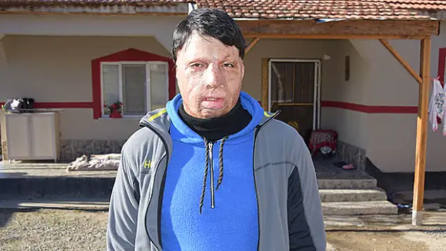Kulu'da tinerle yüzü yanan genç yardım bekliyor