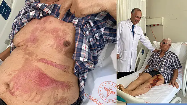 Lavabo açıcı bomba gibi patladı, vücudunun yüzde 40'ı yanan 78 yaşındaki yaşlı adam dehşeti yaşadı
