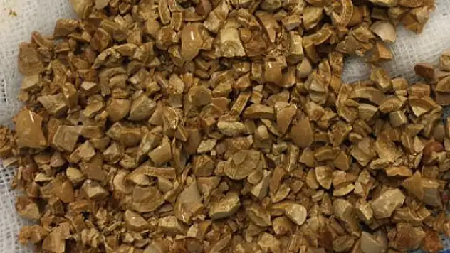 Mesanesinden 1 kilo taş çıktı