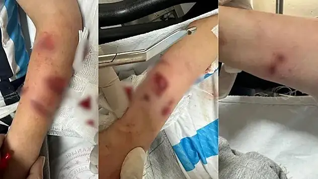 Rize'de sokak köpeklerinin saldırısına uğrayan çocuk yaralandı

