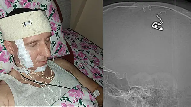 Rusya'da rüyalarını kontrol etmek için matkapla kafatasını delip çip yerleştiren adam hastanelik oldu
