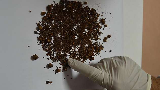 Safra kesesi değil sanki taş ocağı: 4 bin 536 taş çıktı
