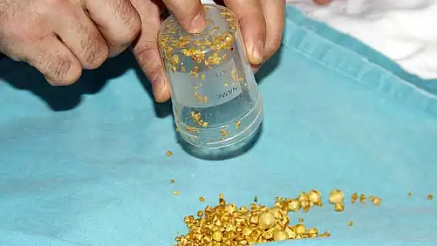 Safra kesesinden 704 taş çıktı