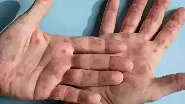 Sakarya'da maymun çiçeği vakası iddiası! Açıklama geldi
