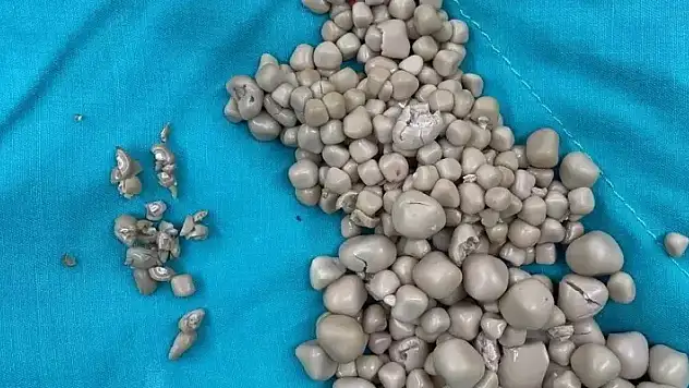 Sırt ağrısı şikayetiyle hastaneye başvurdu: 300'den fazla böbrek taşı çıkarıldı