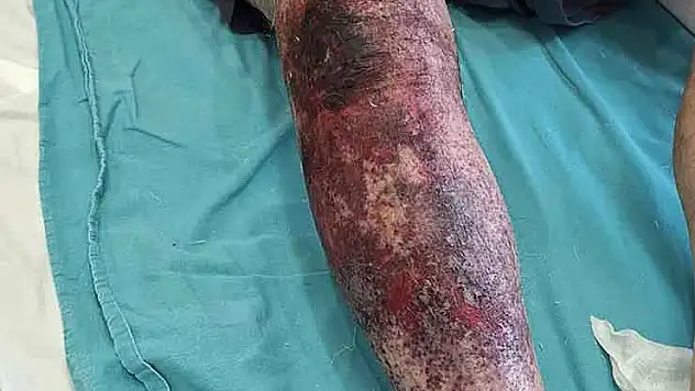 Tıkalı lavaboyu açmaya çalıştı, kimyasal yanıkla hastanelik oldu