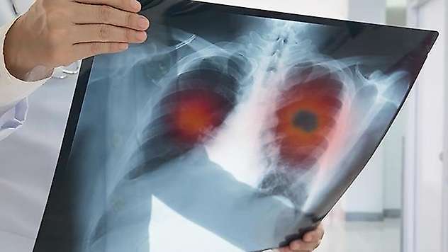 Türkiye'de bir yılda 31 bin kişi akciğer kanserine yakalandı