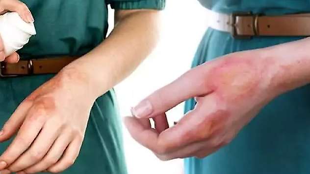 Uzmanından uyarı: Yanıklara diş macunu ve yumurta akıyla müdahale risk teşkil ediyor
