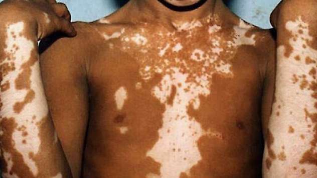 Vitiligo nedir? Nasıl iyileşir?