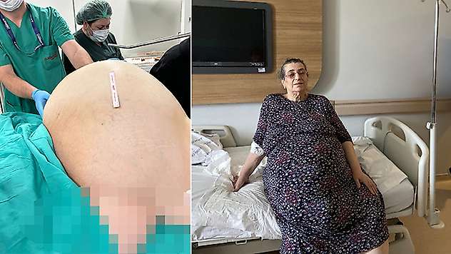 Yumurtalıklarındaki 23 kiloluk kitle operasyonla çıkarıldı doktorlar da şaşırdı