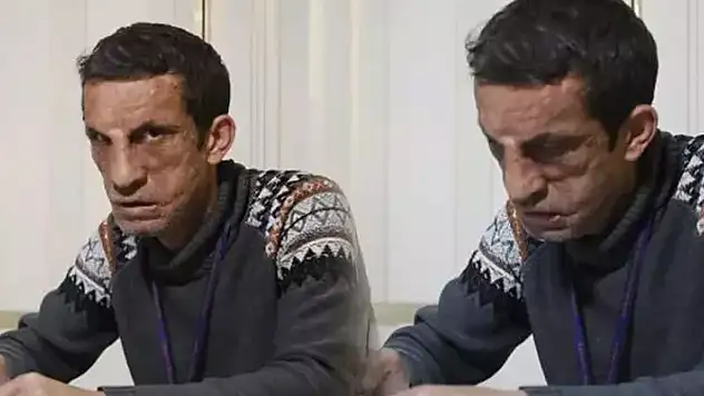Yüz nakli ameliyatı ile yeni hayatına başlayan Uğur Acar'ın yeni hedefi
