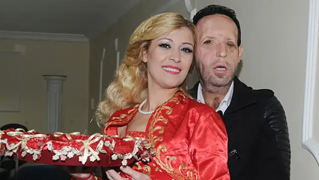 Yüz nakli olan Recep Sert'in kazadan önceki hali!