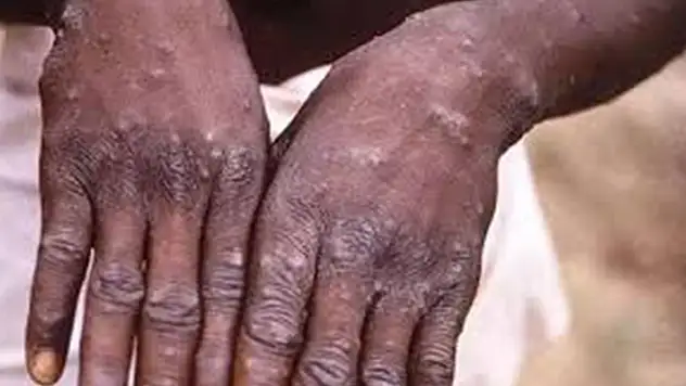 Zimbabve ve Zambiya'da ilk Maymun çiçeği vakaları tespit edildi
